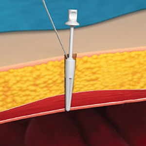 Joystick Laparoscopic Port Closure System | Medline Industries, Inc.